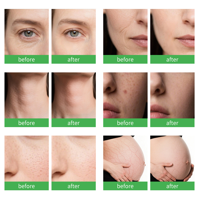 2-7D系列-15寸竖屏7D-15寸竖屏-7D+7D+微针-_06 Wholesale 2 in 1 hifu with rf microneedle machine wrinkle removal face lifting - 图片 5